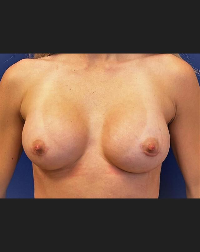 Fat Transfer Breast Augmentation after at John Minoli, MD in Las Vegas, NV