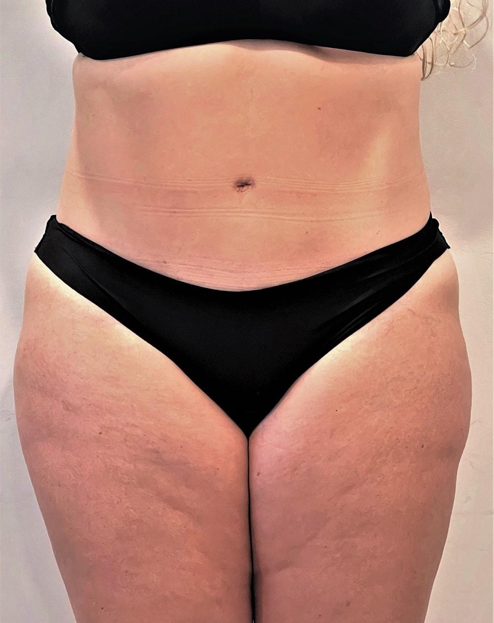 John Minoli, MD tummy tuck after — Las Vegas, NV