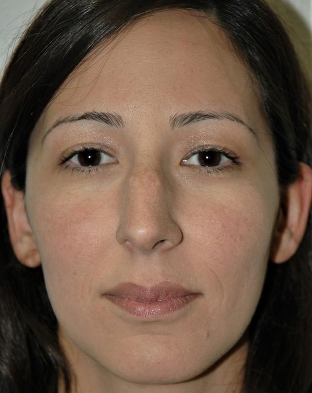 Rhinoplasty before at John Minoli, MD in Las Vegas, NV