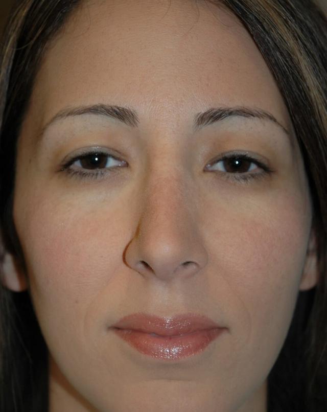Rhinoplasty after at John Minoli, MD in Las Vegas, NV