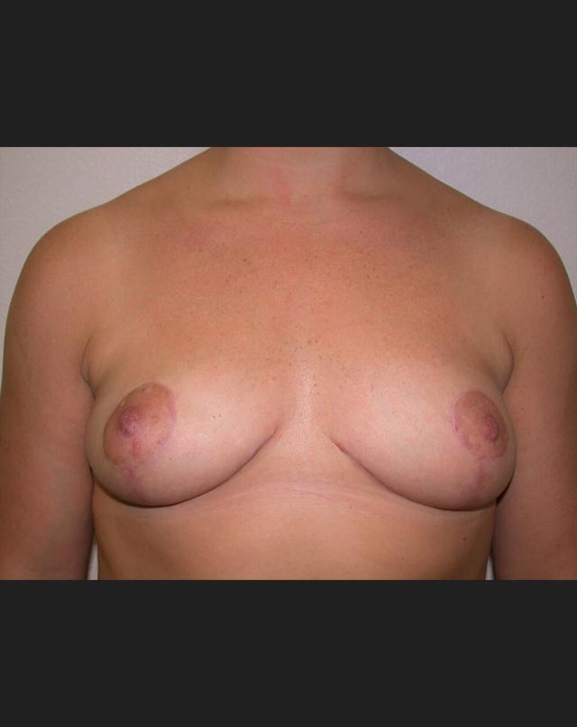 Breast Lift after at John Minoli, MD in Las Vegas, NV