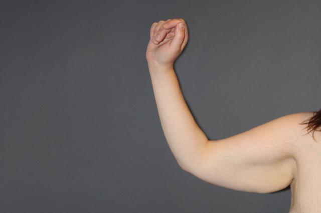 Arm Lift before at Webb Plastic Surgery (Lindsey Webb, MD) in Atlanta, GA