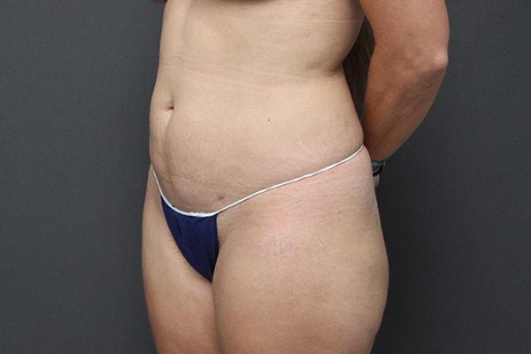 Webb Plastic Surgery (Lindsey Webb, MD) liposuction after — Atlanta, GA