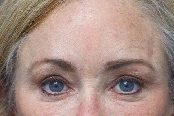 Webb Plastic Surgery (Lindsey Webb, MD) eyelid lift after — Atlanta, GA