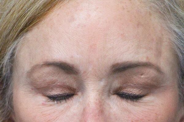 Webb Plastic Surgery (Lindsey Webb, MD) eyelid lift after — Atlanta, GA