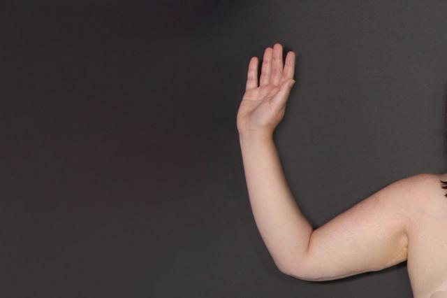 Arm Lift after at Webb Plastic Surgery (Lindsey Webb, MD) in Atlanta, GA