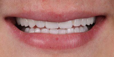Dr. Tyler Hales smile makeover after — Newport Beach, CA