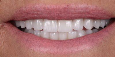 Dr. Tyler Hales smile makeover after — Newport Beach, CA