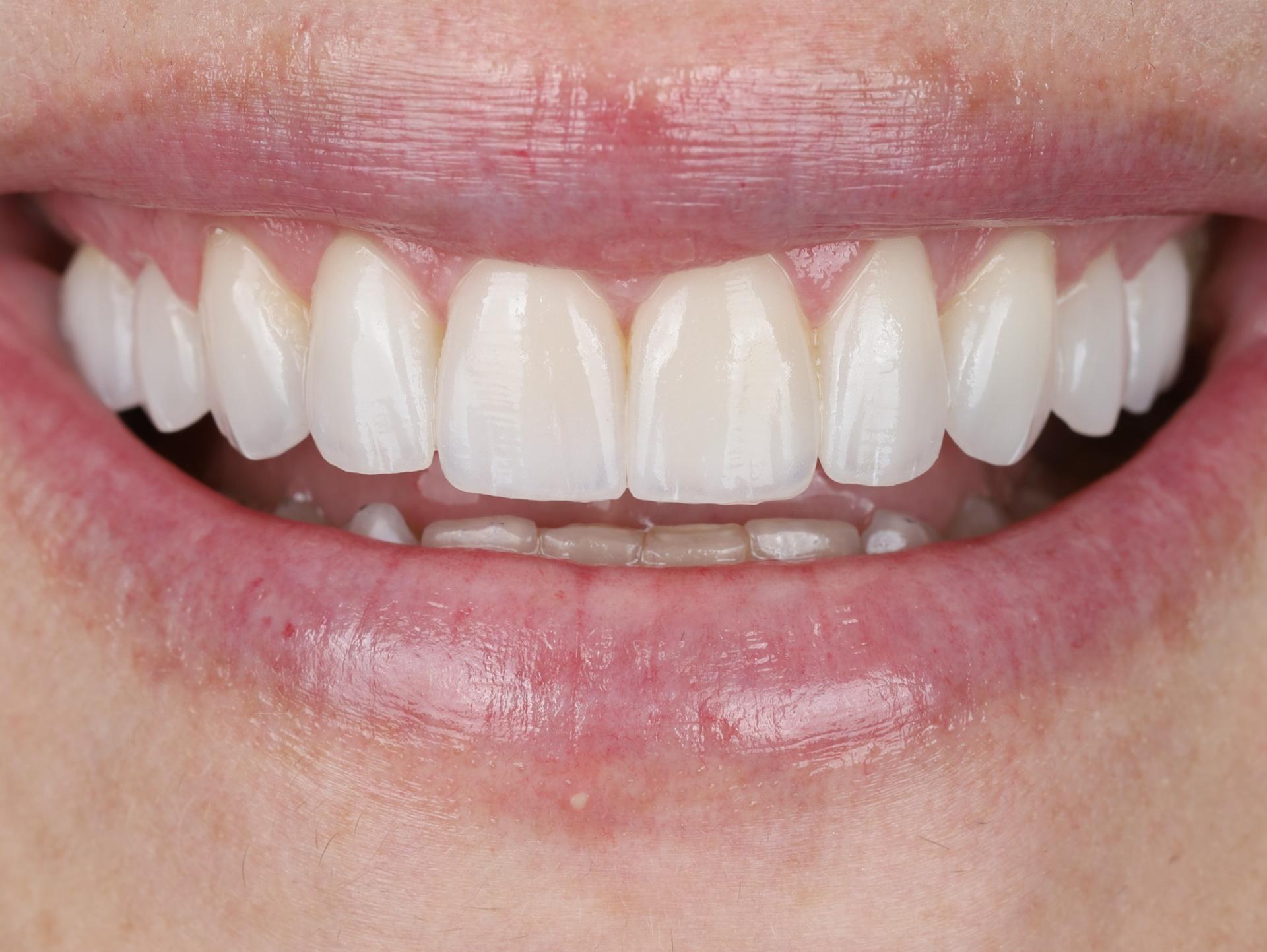 Dr. Tyler Hales veneers after — Newport Beach, CA