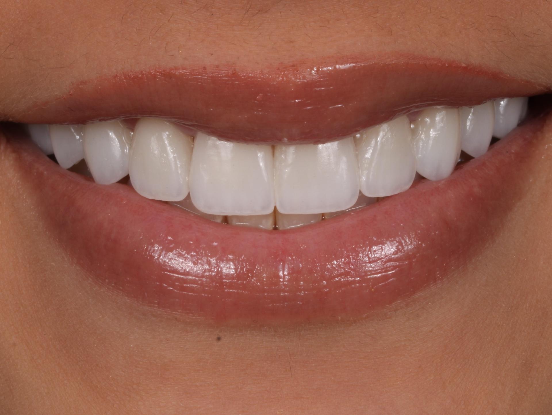 Dr. Tyler Hales veneers after — Newport Beach, CA