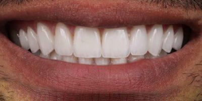 Dental Veneers after at Dr. Tyler Hales in Newport Beach, CA