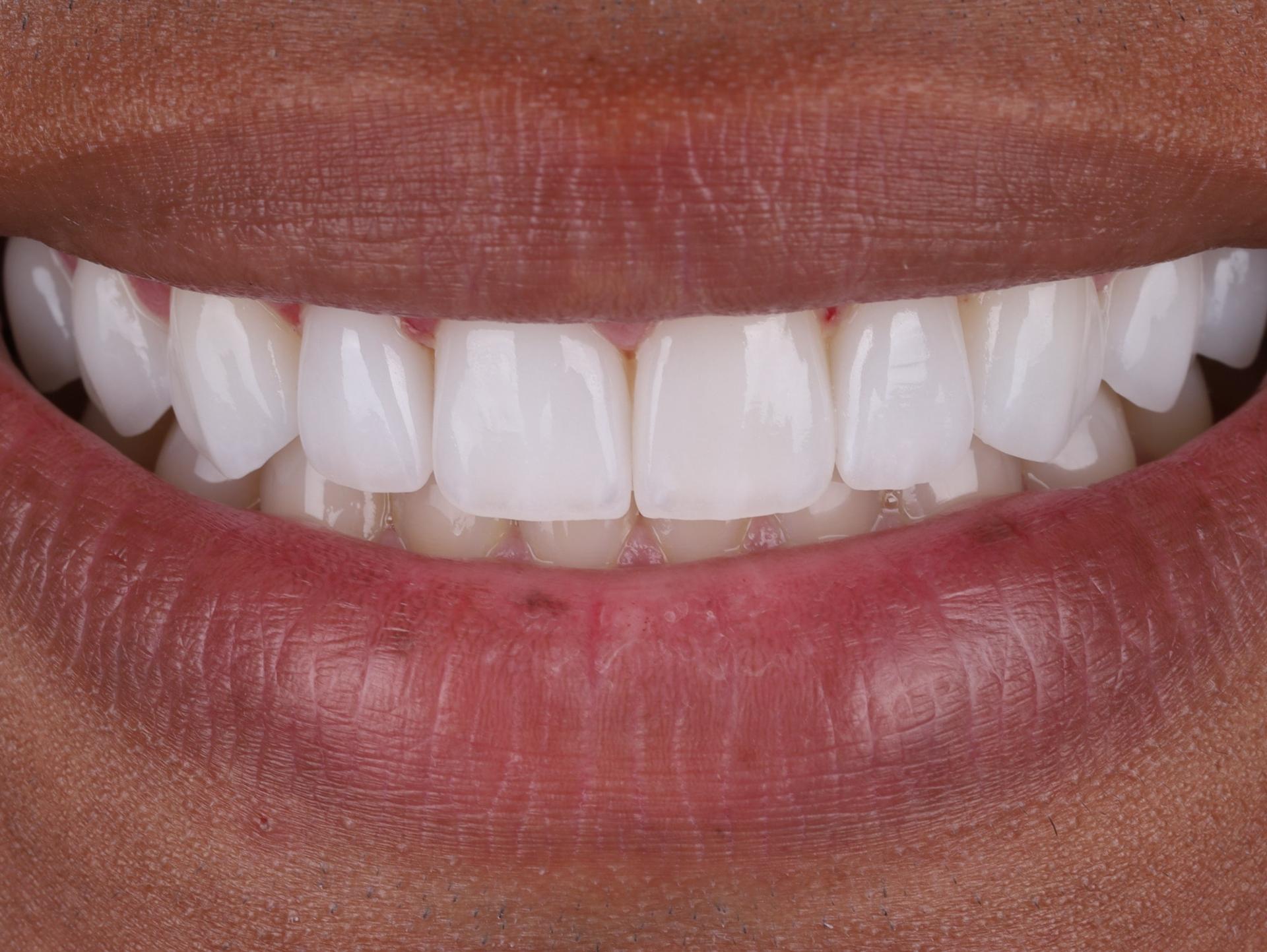 Dr. Tyler Hales veneers after — Newport Beach, CA