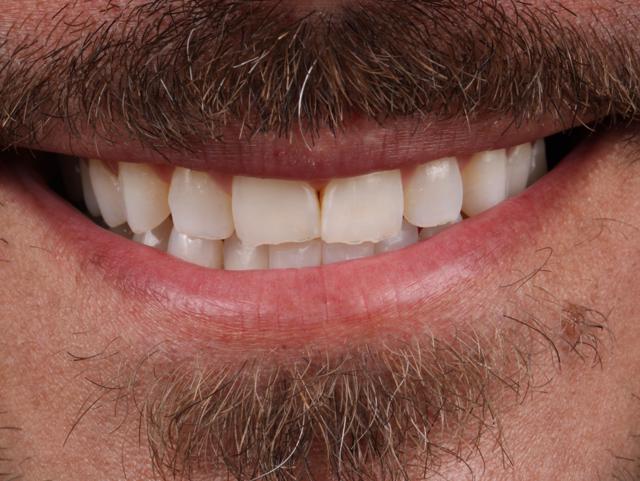 Dental Veneers before at Dr. Tyler Hales in Newport Beach, CA