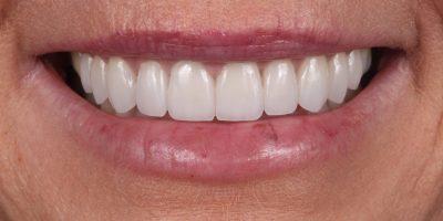 Smile Makeover after at Dr. Tyler Hales in Newport Beach, CA