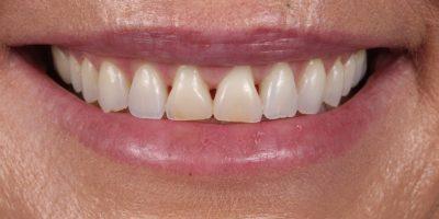 Smile Makeover before at Dr. Tyler Hales in Newport Beach, CA