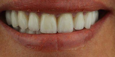 Dental Veneers after at Dr. Tyler Hales in Newport Beach, CA