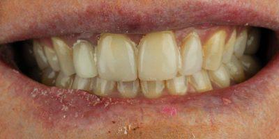 Dental Veneers before at Dr. Tyler Hales in Newport Beach, CA