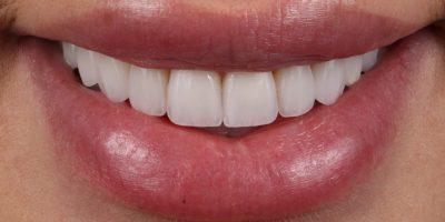 Dr. Tyler Hales smile makeover after — Newport Beach, CA