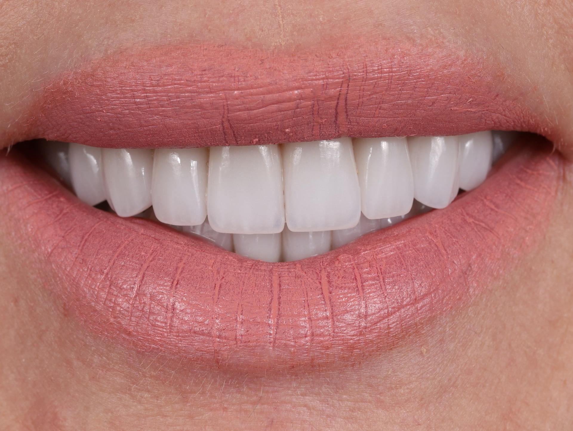 Dr. Tyler Hales veneers after — Newport Beach, CA