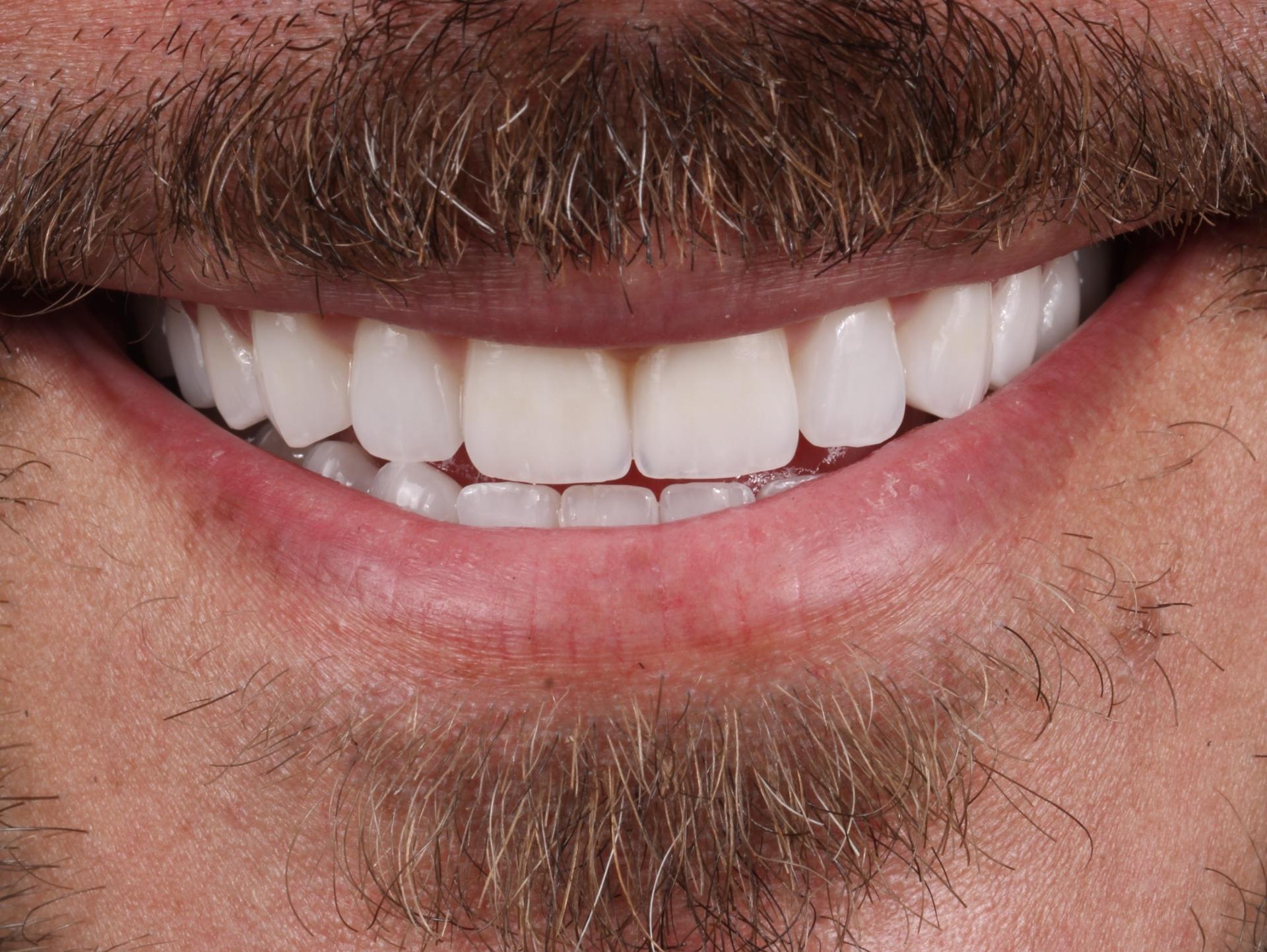 Dr. Tyler Hales veneers after — Newport Beach, CA