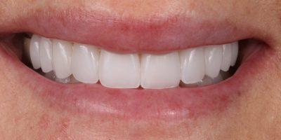 Smile Makeover after at Dr. Tyler Hales in Newport Beach, CA
