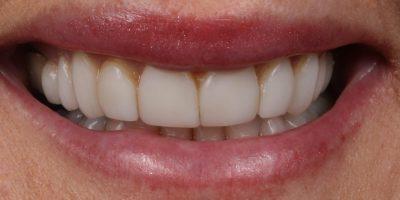Smile Makeover before at Dr. Tyler Hales in Newport Beach, CA