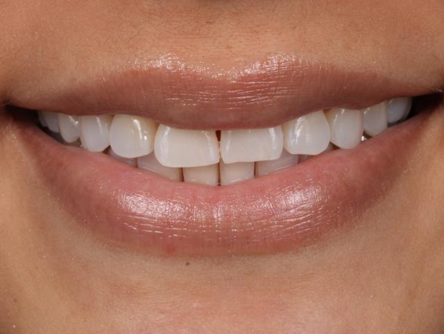 Dental Veneers before at Dr. Tyler Hales in Newport Beach, CA