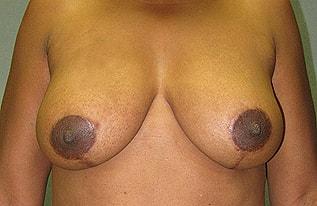 The Aesthetic Institute of Chicago (Brian M. Braithwaite, MD) breast lift after — Chicago, IL