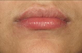 The Aesthetic Institute of Chicago (Brian M. Braithwaite, MD) lip filler after — Chicago, IL