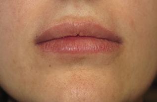 The Aesthetic Institute of Chicago (Brian M. Braithwaite, MD) lip filler after — Chicago, IL