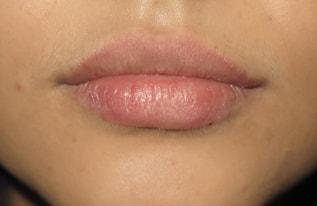 The Aesthetic Institute of Chicago (Brian M. Braithwaite, MD) lip filler after — Chicago, IL