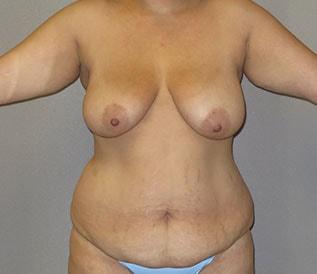 Mommy Makeover before at The Aesthetic Institute of Chicago (Brian M. Braithwaite, MD) in Chicago, IL