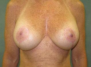 The Aesthetic Institute of Chicago (Brian M. Braithwaite, MD) breast augmentation revision after — Chicago, IL