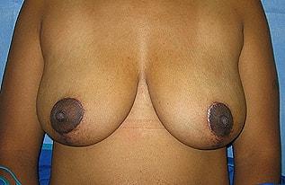 The Aesthetic Institute of Chicago (Brian M. Braithwaite, MD) breast lift after — Chicago, IL