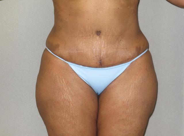 Tummy Tuck after at The Aesthetic Institute of Chicago (Brian M. Braithwaite, MD) in Chicago, IL