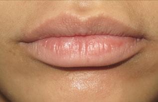 The Aesthetic Institute of Chicago (Brian M. Braithwaite, MD) lip filler after — Chicago, IL