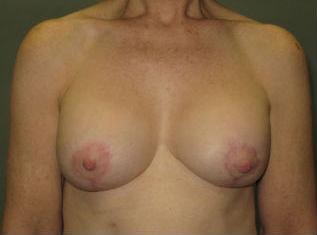 The Aesthetic Institute of Chicago (Brian M. Braithwaite, MD) breast augmentation revision after — Chicago, IL
