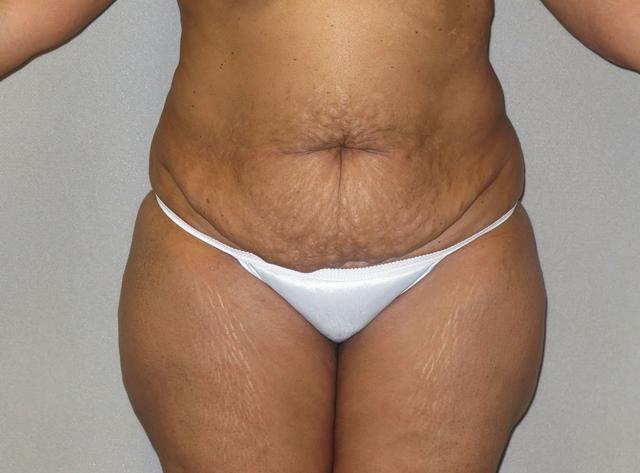 Tummy Tuck before at The Aesthetic Institute of Chicago (Brian M. Braithwaite, MD) in Chicago, IL