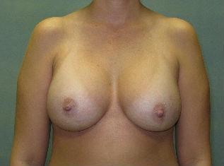 The Aesthetic Institute of Chicago (Brian M. Braithwaite, MD) breast augmentation revision after — Chicago, IL