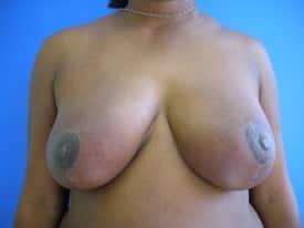 Breast Reduction after at Cosmetic Plastic Surgery & Wellness Club of Maryland in Hanover, MD