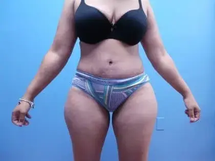 Cosmetic Plastic Surgery & Wellness Club of Maryland tummy tuck after — Hanover, MD