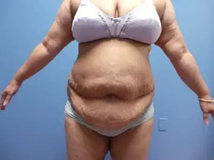 Mini Tummy Tuck before at Cosmetic Plastic Surgery & Wellness Club of Maryland in Hanover, MD