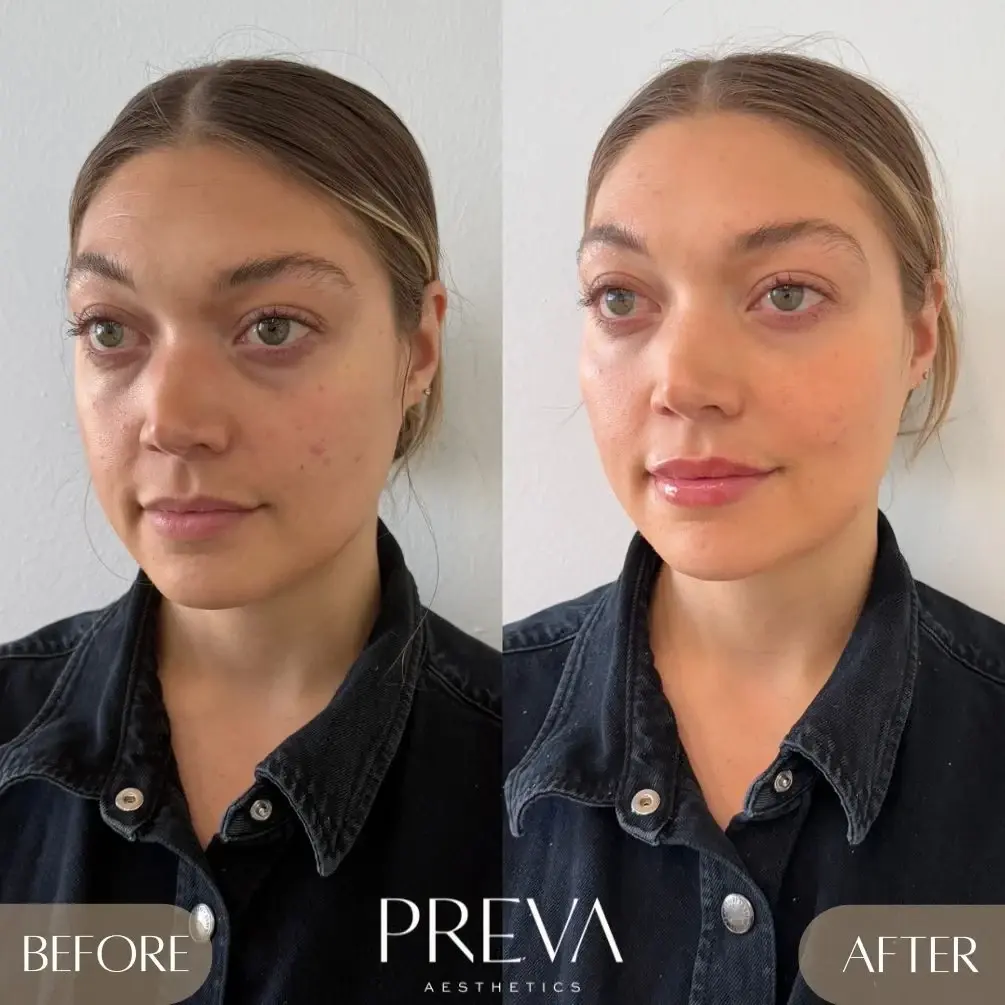 PREVA Aesthetics lip filler result — Encinitas, CA