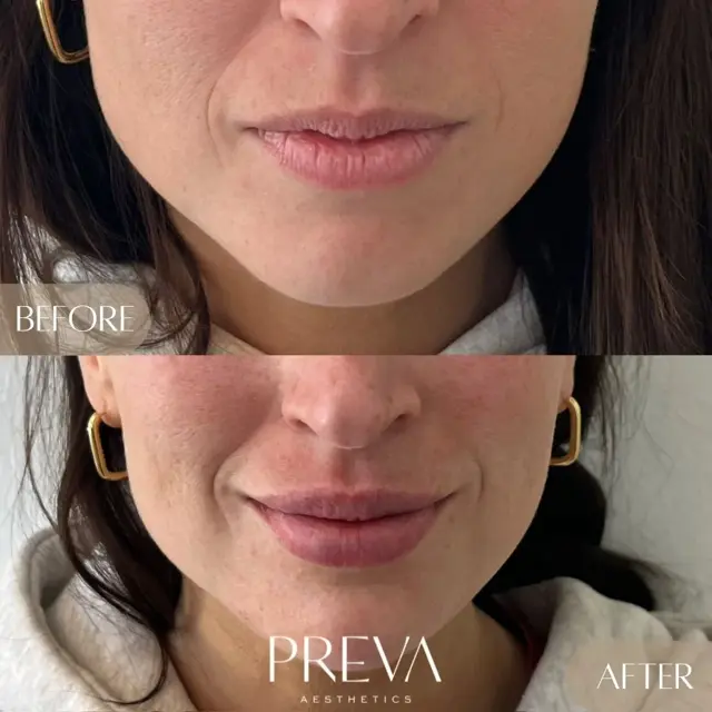 Lip Filler after at PREVA Aesthetics in Encinitas, CA