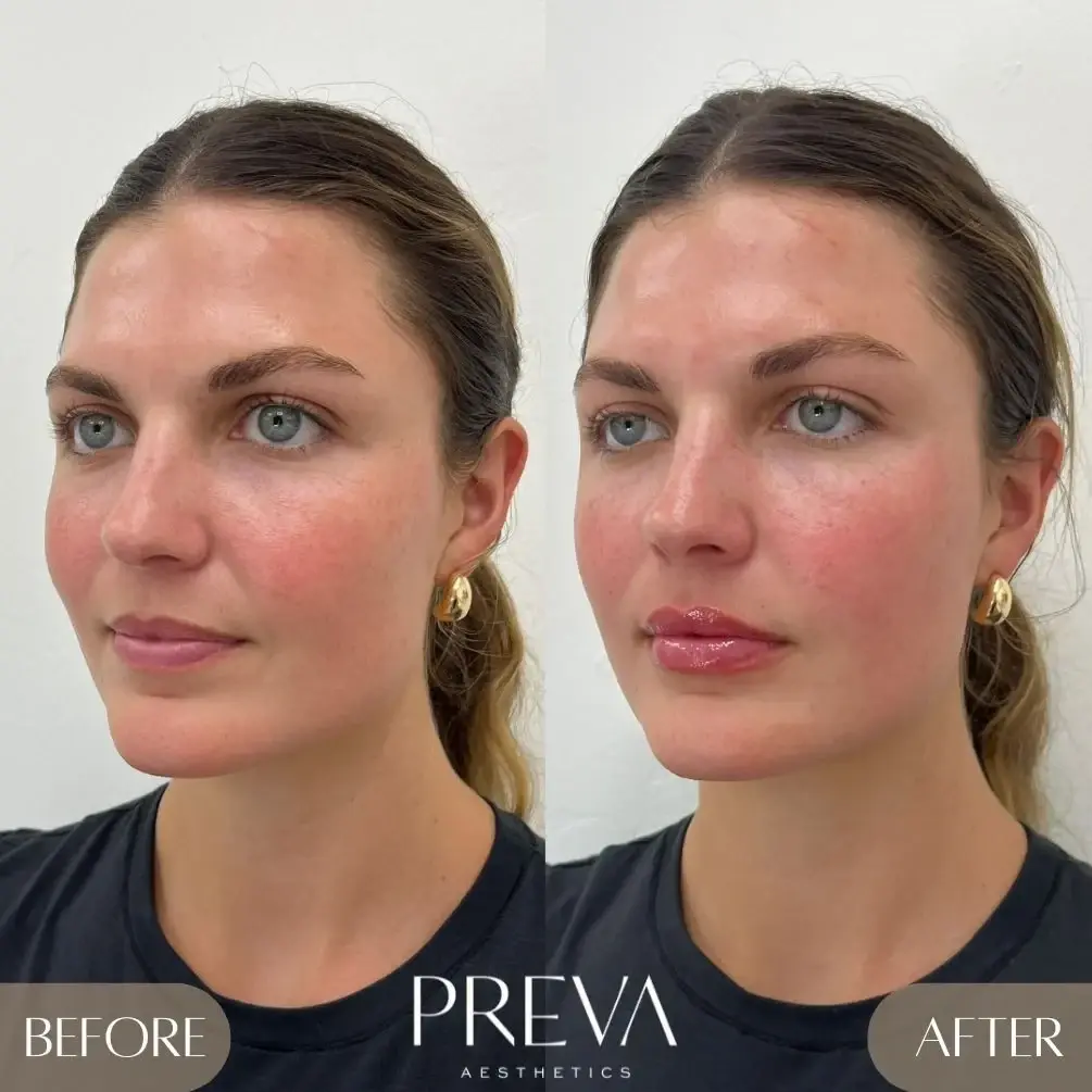 PREVA Aesthetics lip filler result — Encinitas, CA
