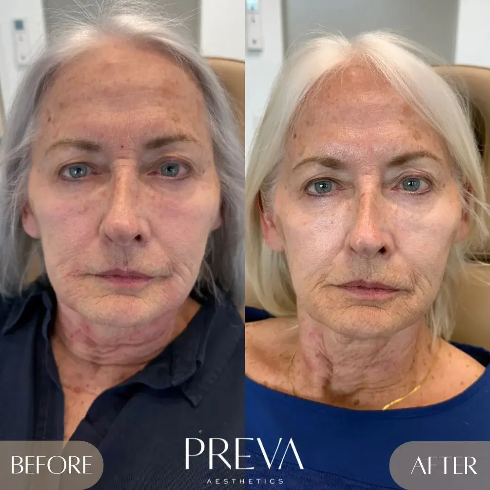 PREVA Aesthetics after — Encinitas, CA