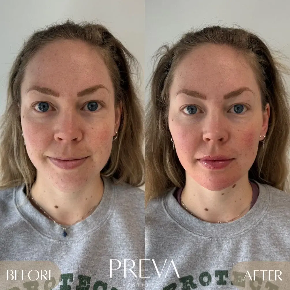 PREVA Aesthetics after — Encinitas, CA