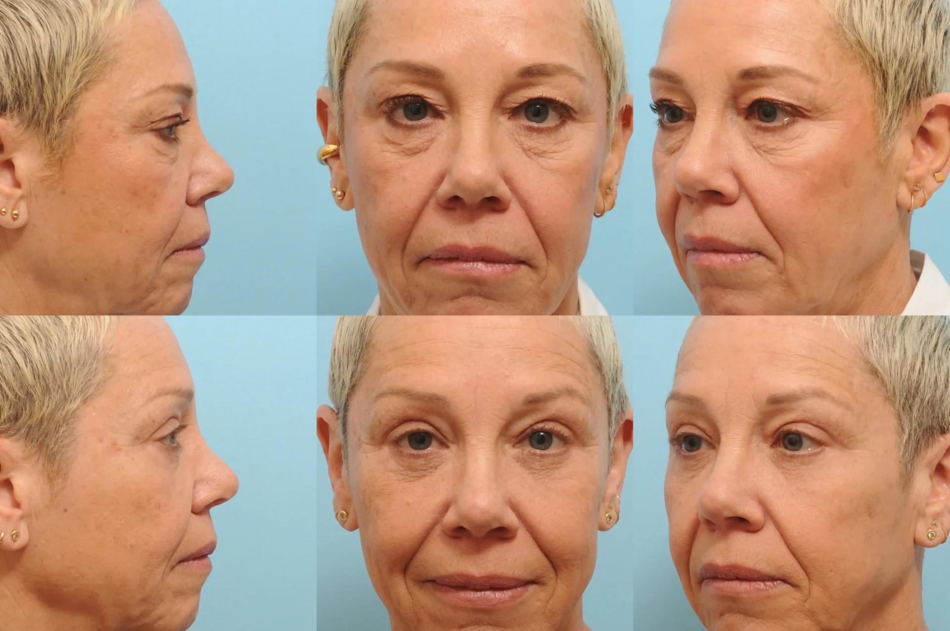 The Plastic Surgery Group eyelid lift result — Montclair, NJ