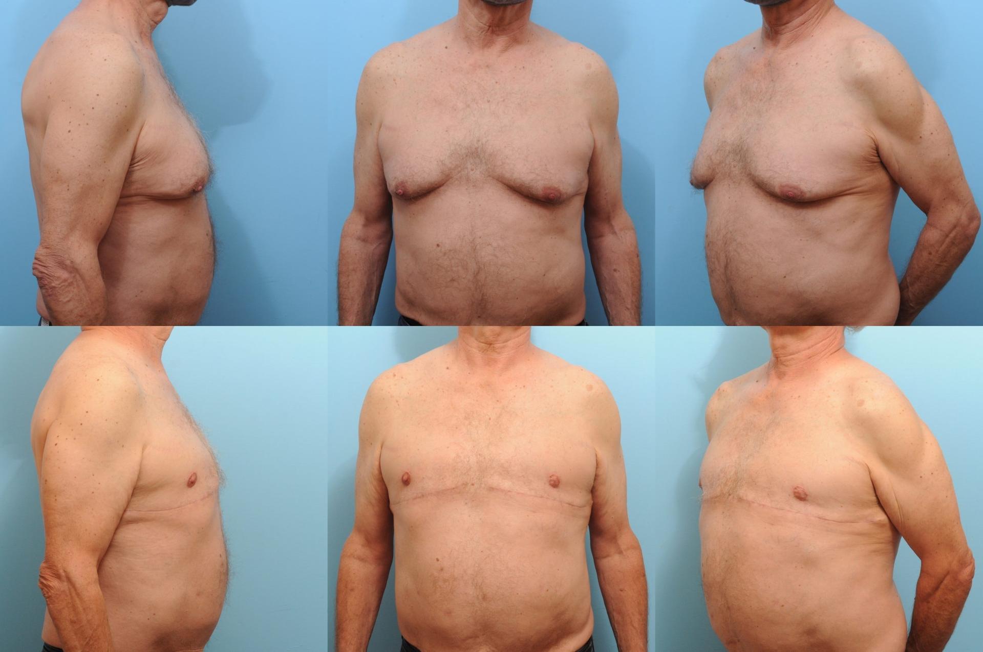 The Plastic Surgery Group gynecomastia result — Montclair, NJ
