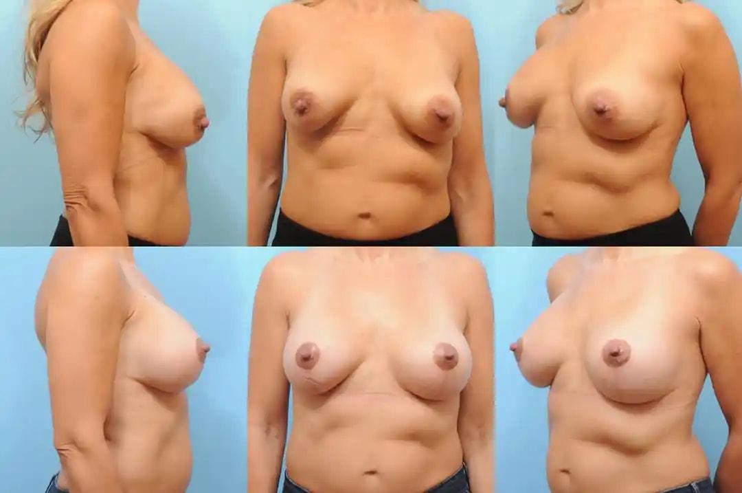 The Plastic Surgery Group breast augmentation revision result — Montclair, NJ